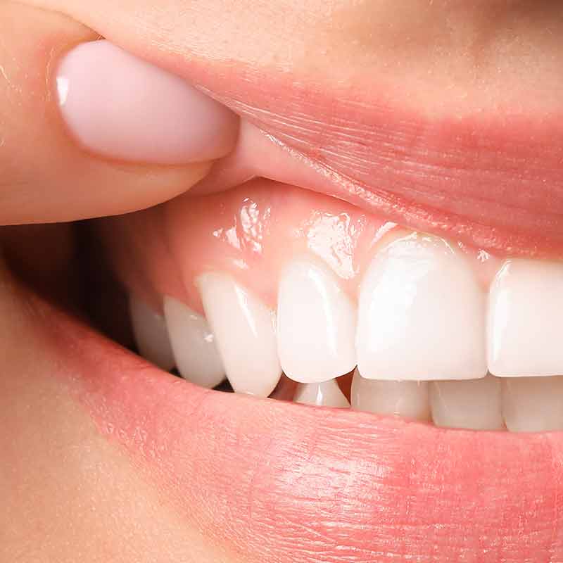 l-zahnfleischbehandlung2