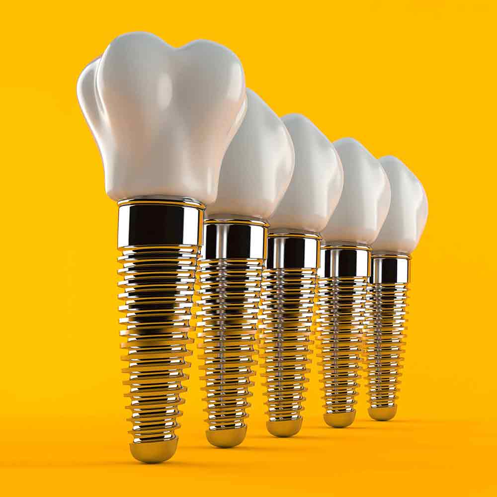l-zahnimplantate